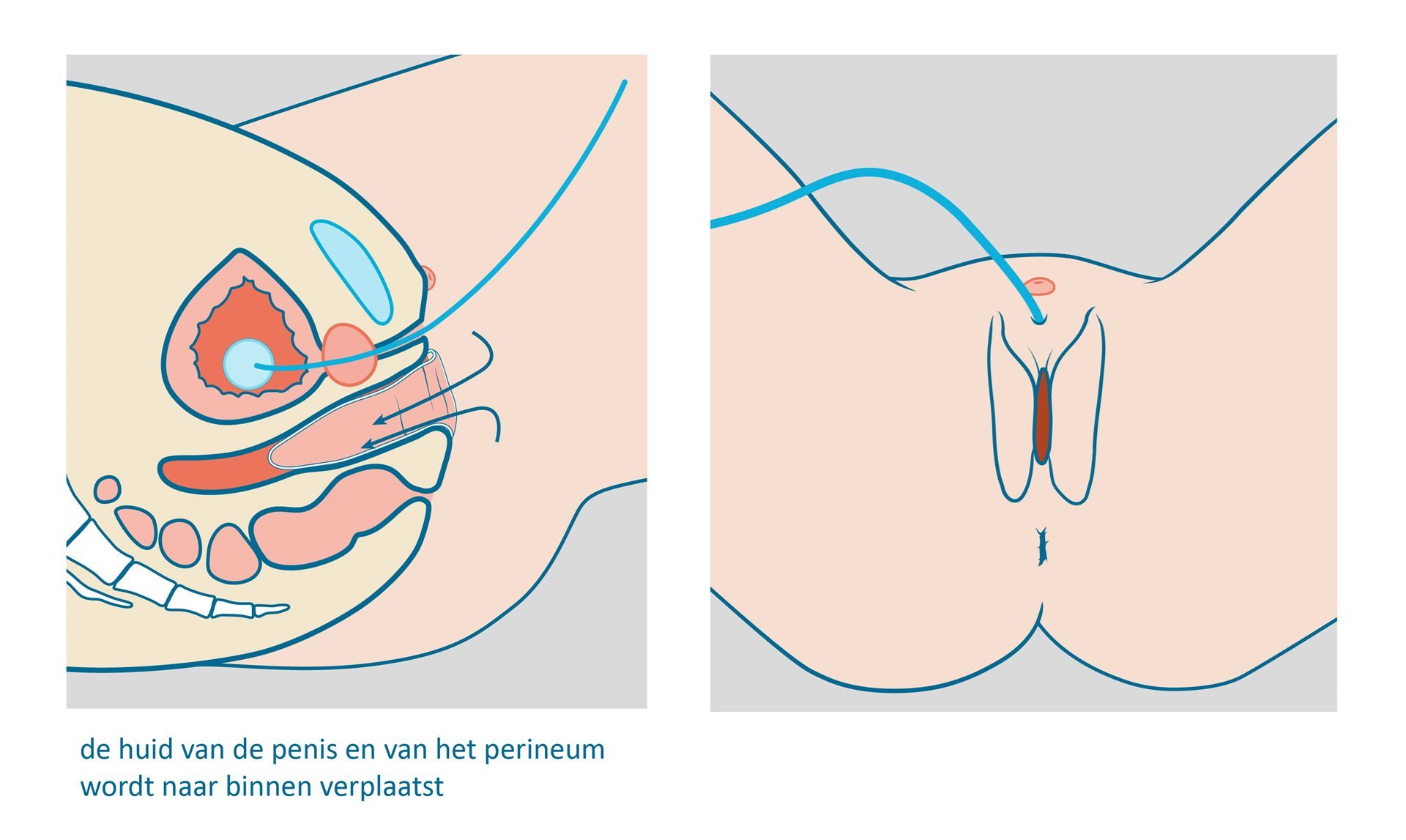 eeuw koppeling Aanvulling Penisinversie vaginaplastiek - Radboudumc